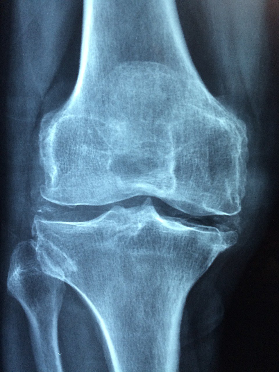 Mediale meniscus letsel, is letsel aan het binnenste schijfje kraakbeen in het kniegewricht.